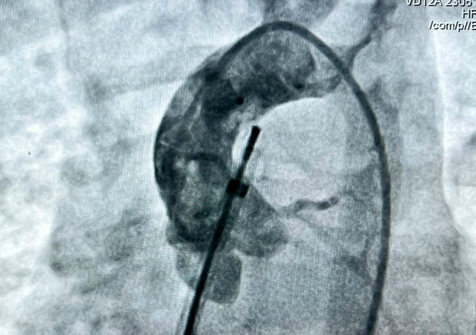 Aorto pulmonary window jodhpur