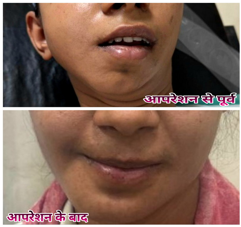 डिस्ट्रैक्टर डिवाइस तकनीक से चेहरे की जटिल विकृति का सफल उपचार