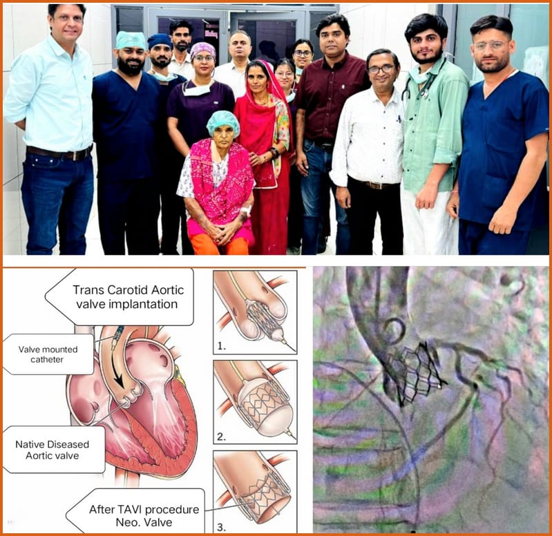 गर्दन की नस से बिना चीरफाड़ बदल दिया सिकुड़ा वॉल्व